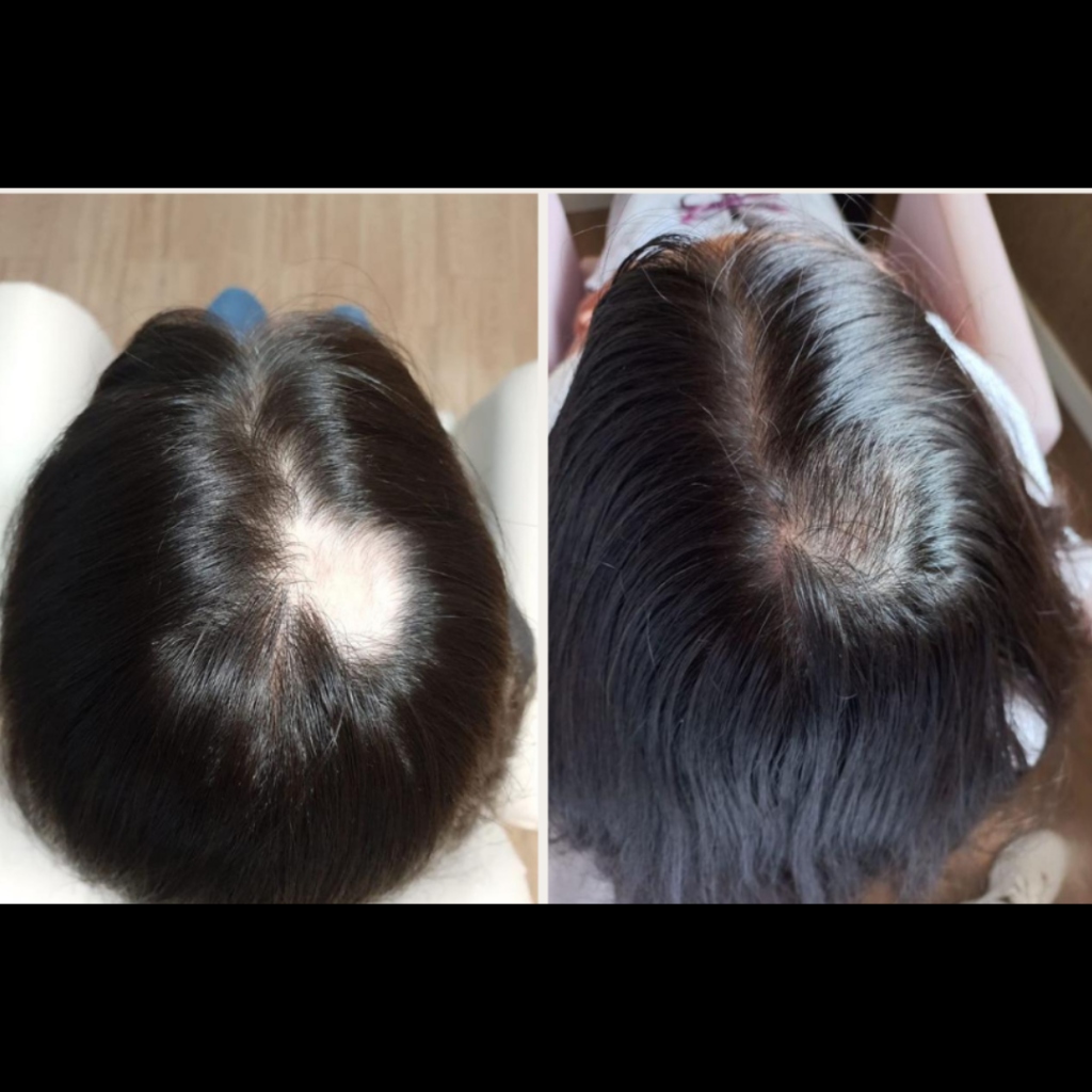 Antes e Depois