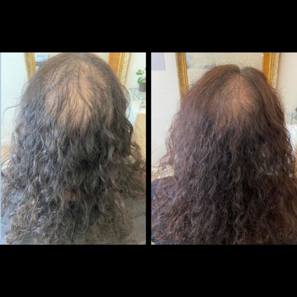 Antes e Depois